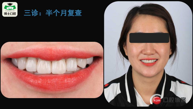前牙树脂贴面失败二次瓷贴面修复病例.jpg