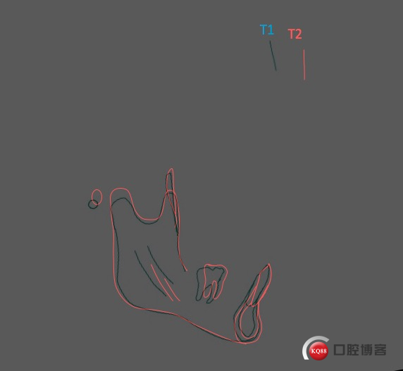 下颌重叠.jpeg
