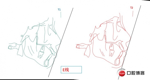 E线.jpeg