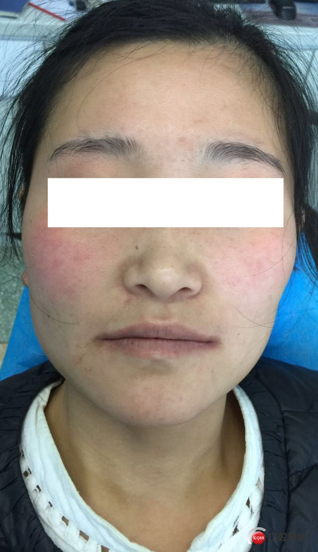 一周后正面_副本.jpg