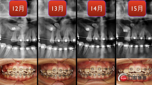 Forum病例投稿-潘超-南昌解放军第94医院.021.jpg
