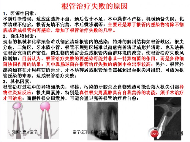 根管再治疗与根尖手术6.png