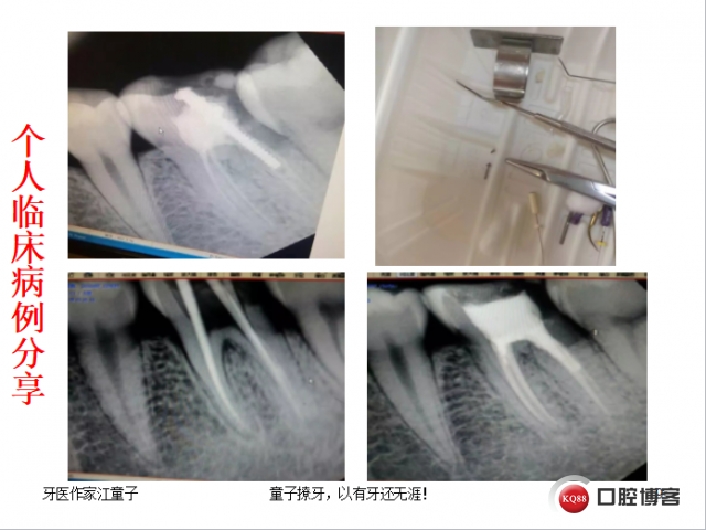 根管再治疗与根尖手术12.png