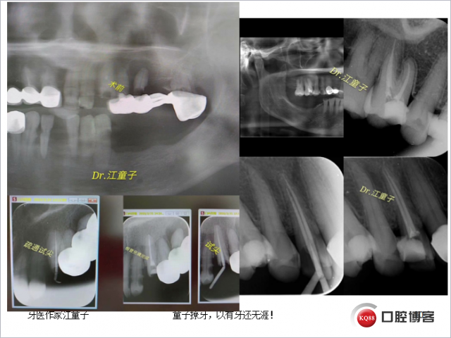 根管再治疗与根尖手术13.png