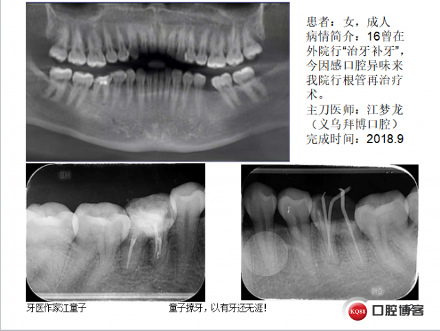 根管再治疗与根尖手术15.png
