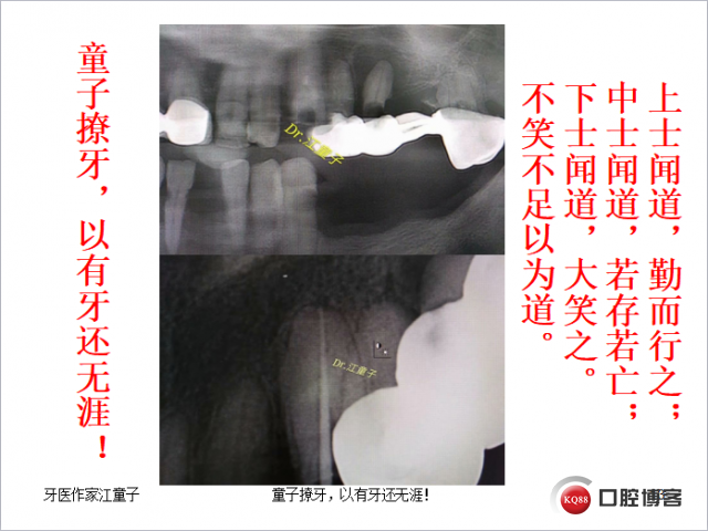 根管再治疗与根尖手术16.png