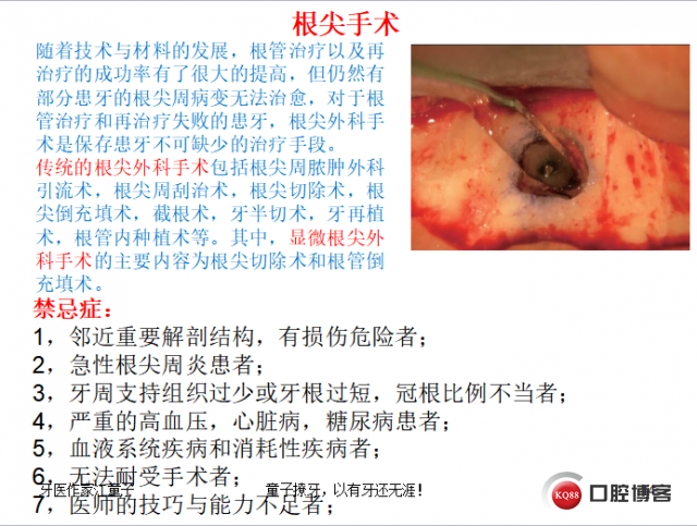 根管再治疗与根尖手术17.png