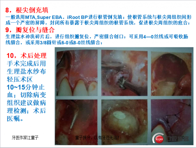根管再治疗与根尖手术20.png