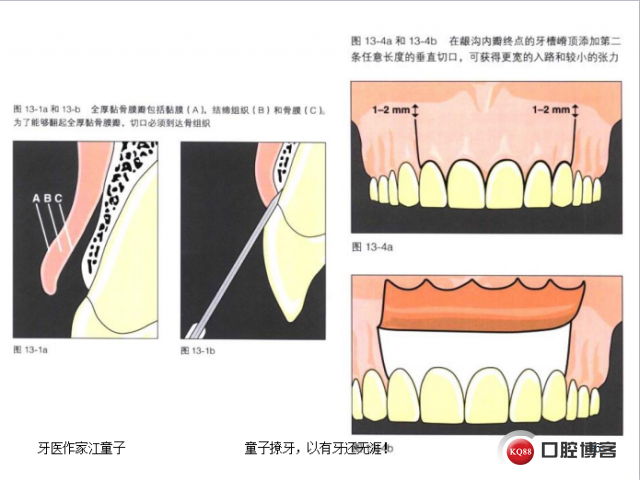 根管再治疗与根尖手术21.png