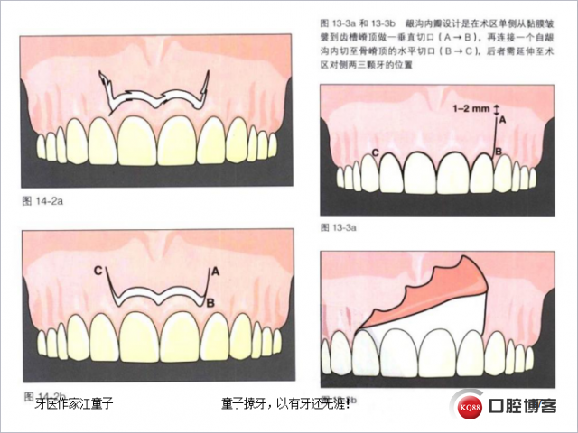 根管再治疗与根尖手术22.png