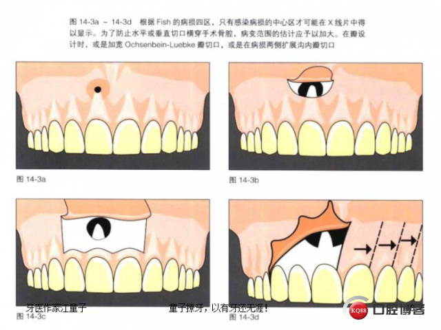 根管再治疗与根尖手术23.png