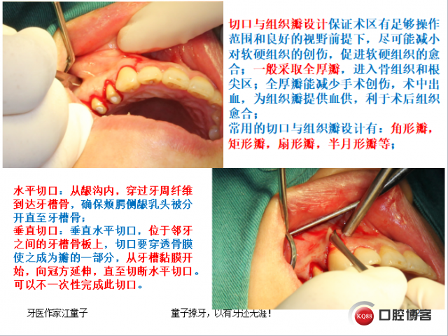 根管再治疗与根尖手术24.png