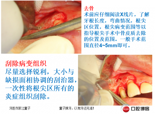 根管再治疗与根尖手术25.png