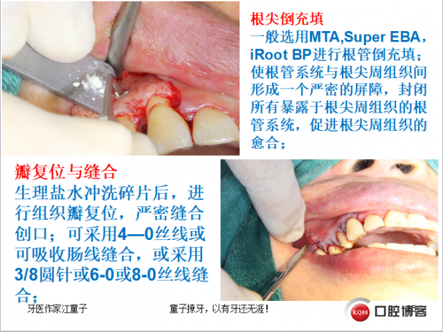 根管再治疗与根尖手术27.png
