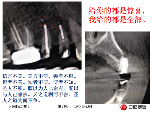 根管再治疗与根尖手术28.png