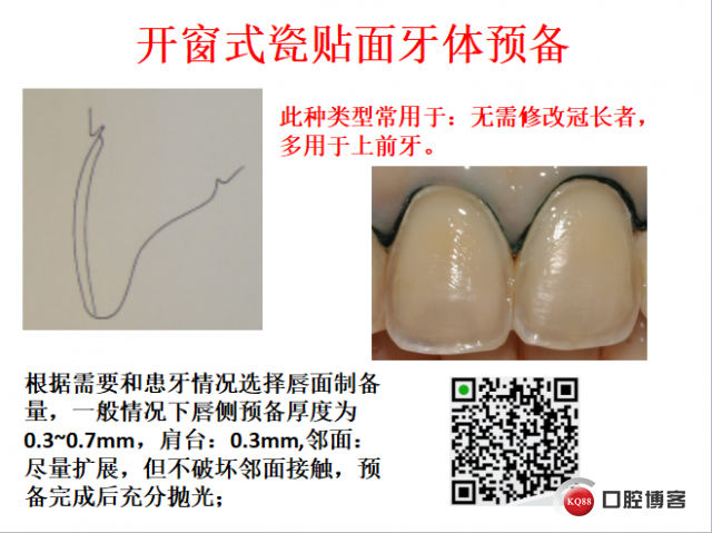 美学瓷贴面修复临床探讨5.png
