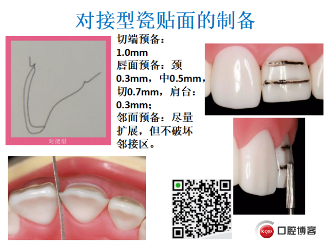 美学瓷贴面修复临床探讨6.png