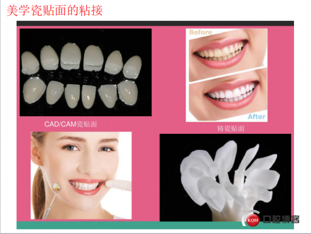 美学瓷贴面修复临床探讨10.png