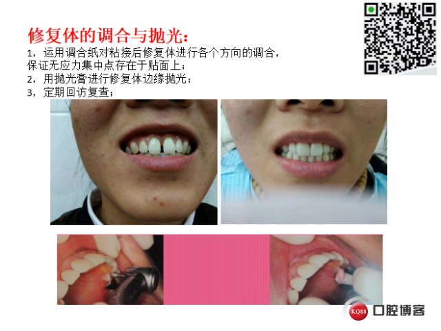 美学瓷贴面修复临床探讨15.png
