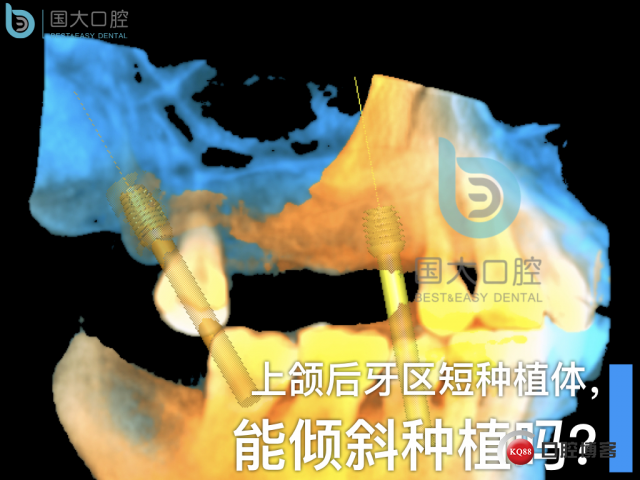 徐福强百康短种植倾斜种植”.001.jpeg
