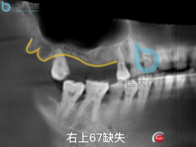徐福强百康短种植倾斜种植”.002.jpeg
