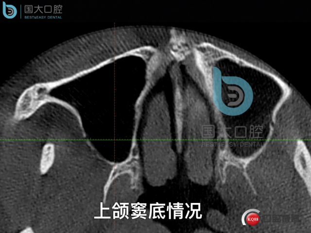 徐福强百康短种植倾斜种植”.004.jpeg