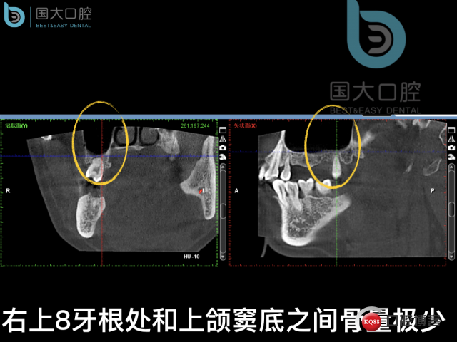 徐福强百康短种植倾斜种植”.006.jpeg