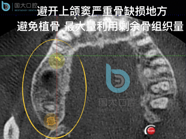 徐福强百康短种植倾斜种植”.012.jpeg