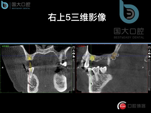 徐福强百康短种植倾斜种植”.013.jpeg