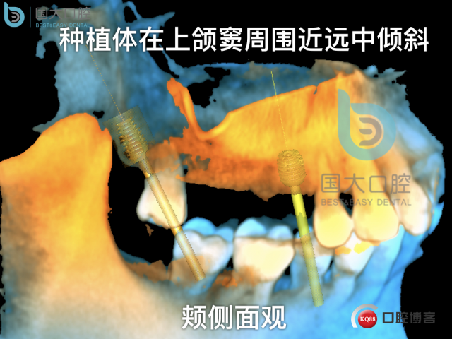 徐福强百康短种植倾斜种植”.017.jpeg