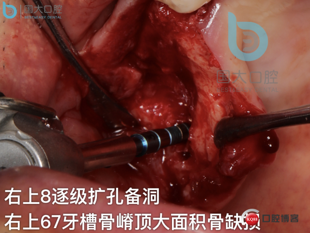 徐福强百康短种植倾斜种植”.025.jpeg