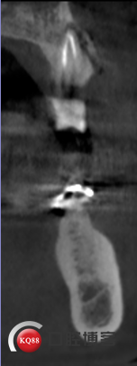 术后即刻3.png