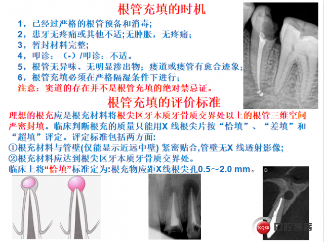 根尖周囊肿.png