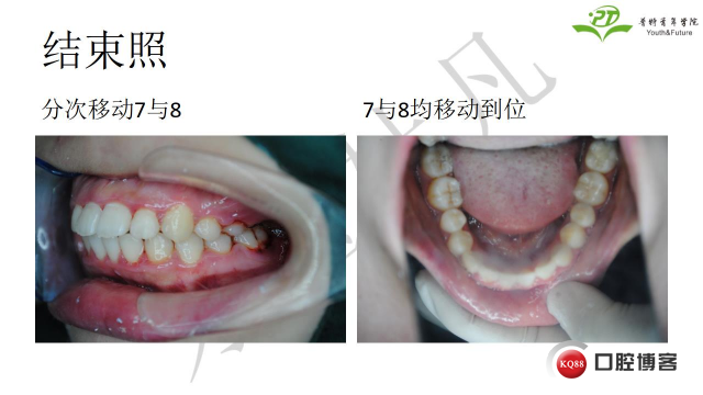 如何避免正畸陷阱！2.jpg_0050.jpg