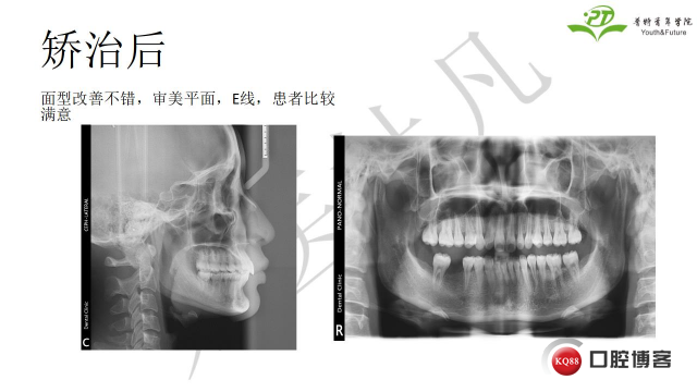 如何避免正畸陷阱！2.jpg_0056.jpg