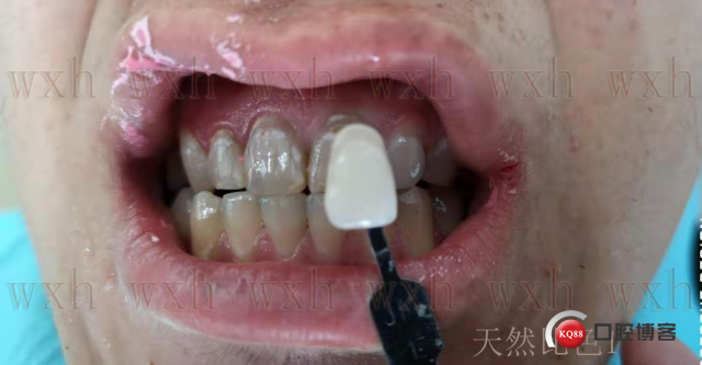 天然牙比色1 复制.jpg