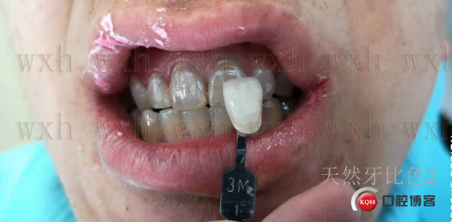 天然牙比色2 复制.jpg