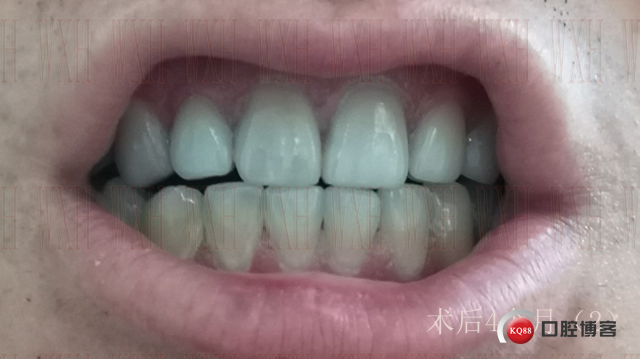 术后4个月 (2) 复制.jpg