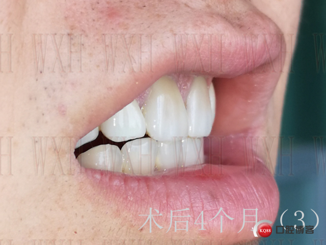 术后4个月 (3) 复制.jpg