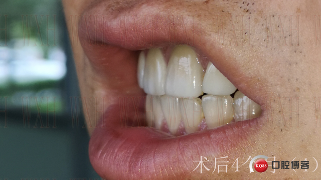 术后4个月 (4) 复制.jpg