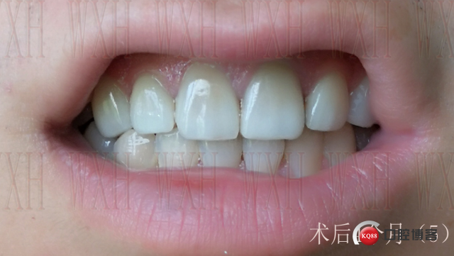 术后4个月 (5) 复制.jpg