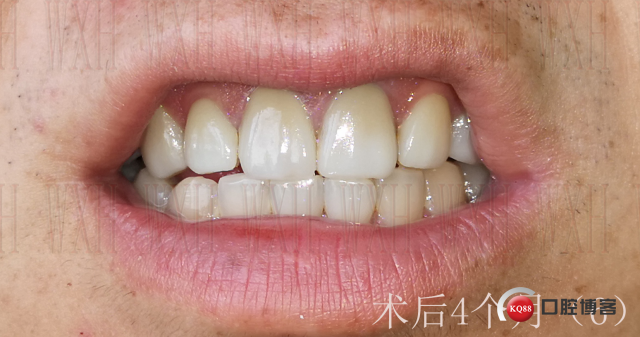 术后4个月 (6) 复制.jpg