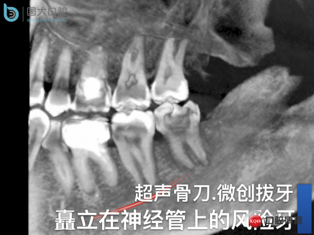 尹宽 余姚 左下8 智齿拔除 直立牙齿.001.jpeg