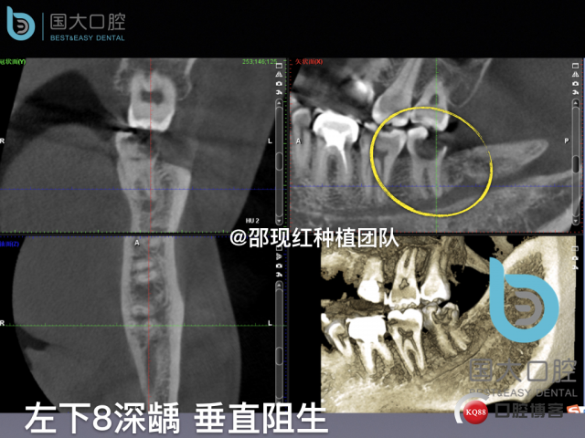尹宽 余姚 左下8 智齿拔除 直立牙齿.009.jpeg