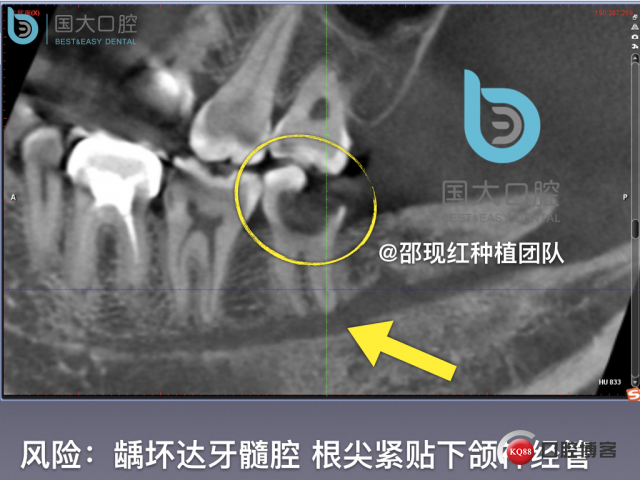 尹宽 余姚 左下8 智齿拔除 直立牙齿.010.jpeg