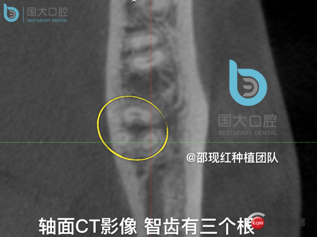 尹宽 余姚 左下8 智齿拔除 直立牙齿.011.jpeg