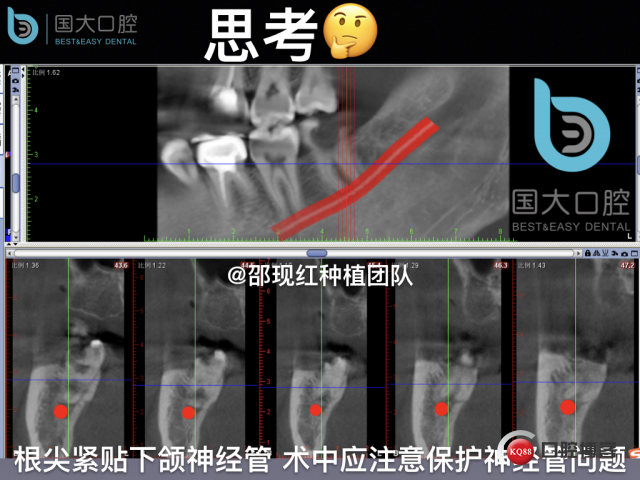 尹宽 余姚 左下8 智齿拔除 直立牙齿.012.jpeg