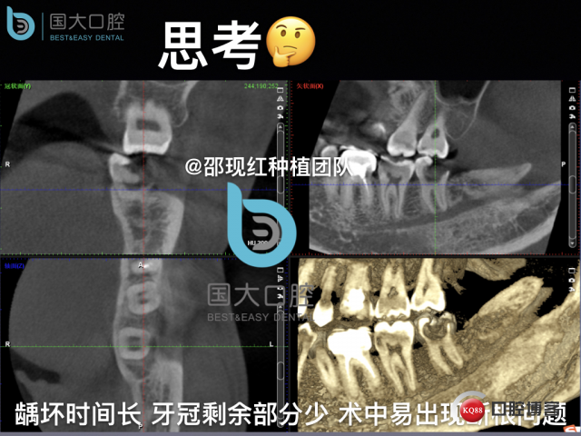 尹宽 余姚 左下8 智齿拔除 直立牙齿.013.jpeg