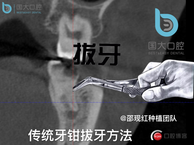 尹宽 余姚 左下8 智齿拔除 直立牙齿.014.jpeg
