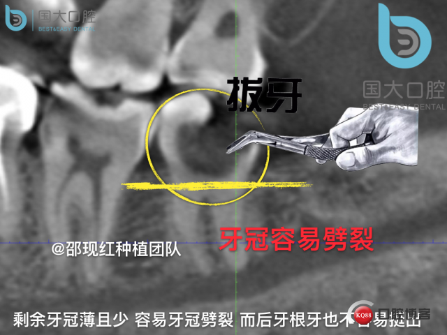 尹宽 余姚 左下8 智齿拔除 直立牙齿.015.jpeg